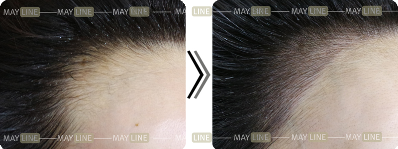 自信のある額ライン完成でストレスまで解決してくれるヘアラインアートメイク