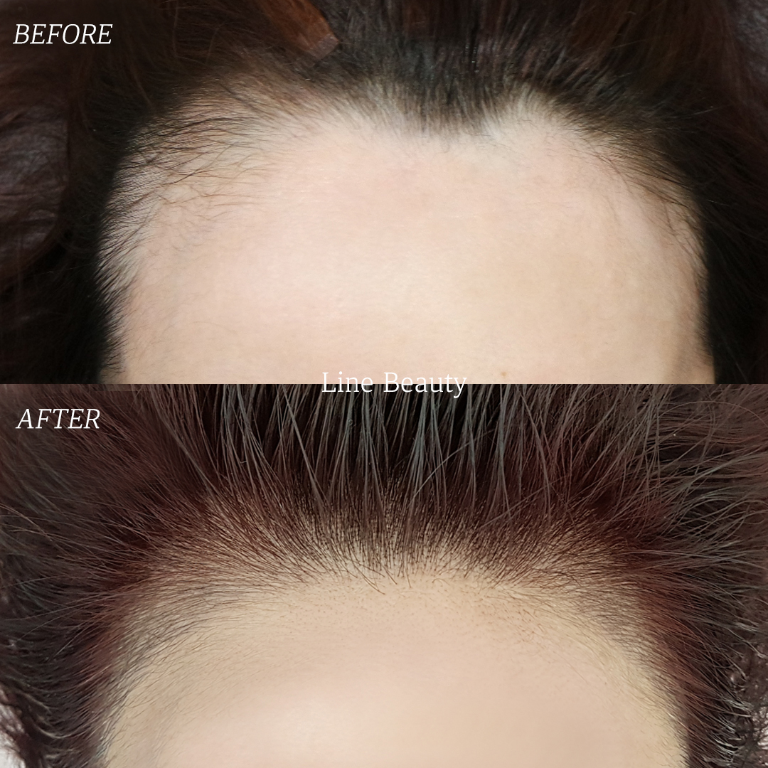 生え際アートメイクでおでこをせまく　(ヘアライン)