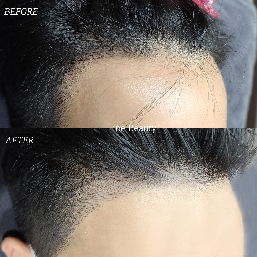 小顔になれるヘアラインアートメイク