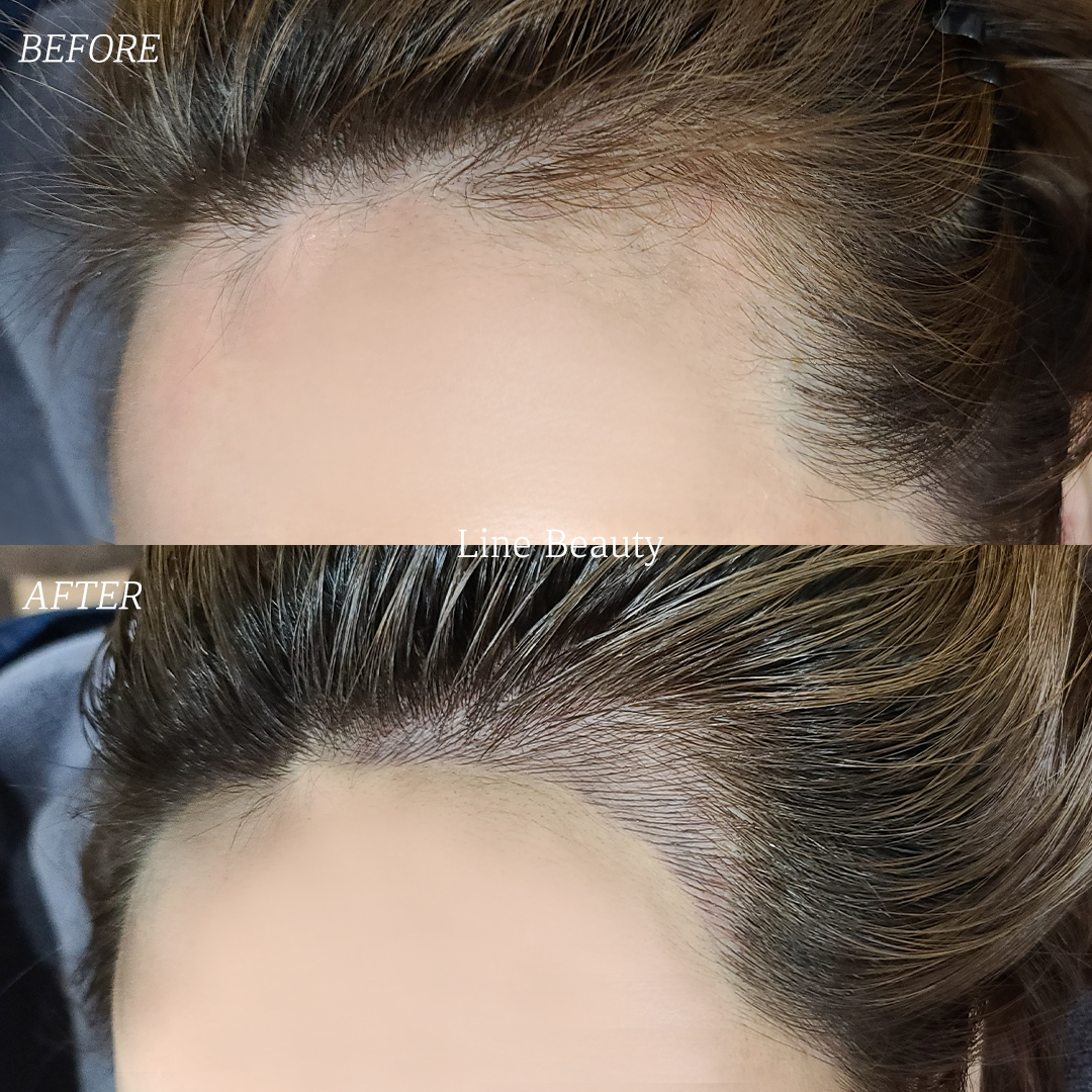 おでこが丸くなって小顔になるヘアラインアートメイク