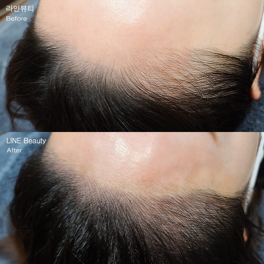 綺麗に整えたヘアライン(生え際)アートメイク