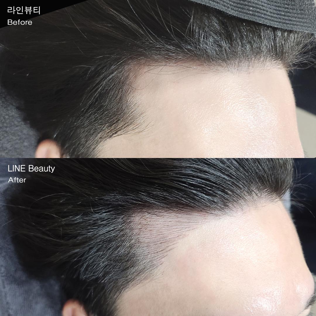 男性の薄毛にヘアライン(生え際)アートメイク