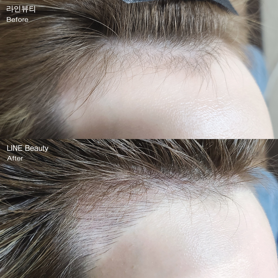 毎日綺麗なヘアラインを保つ ヘアライン（生え際）アートメイク